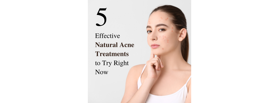 5 Effective Natural Acne Treatments to Try Right Now